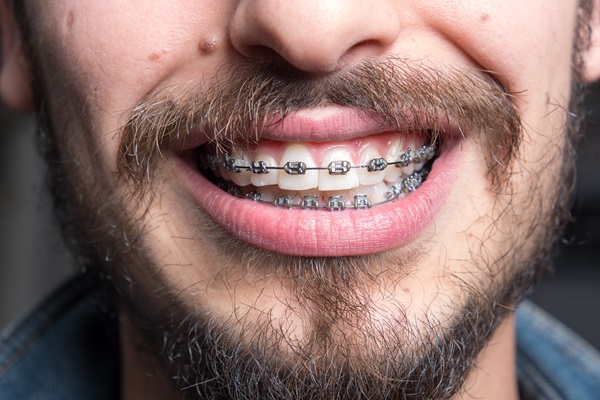 How An Orthodontist Can Straighten Crooked Teeth